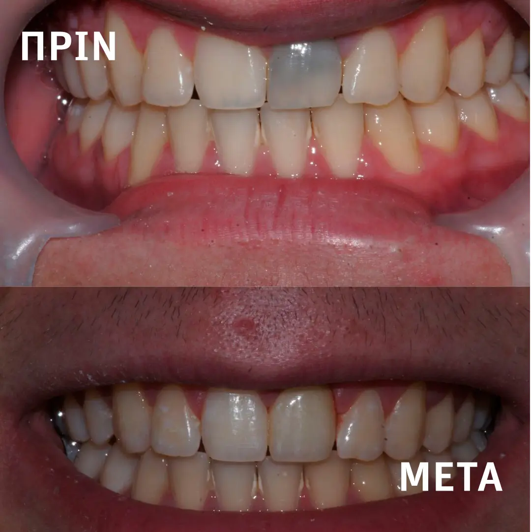 Πρότυπη οδοντιατρική κλινική Σιδέρη Σέρρες Θήκη Ζιρκονίου