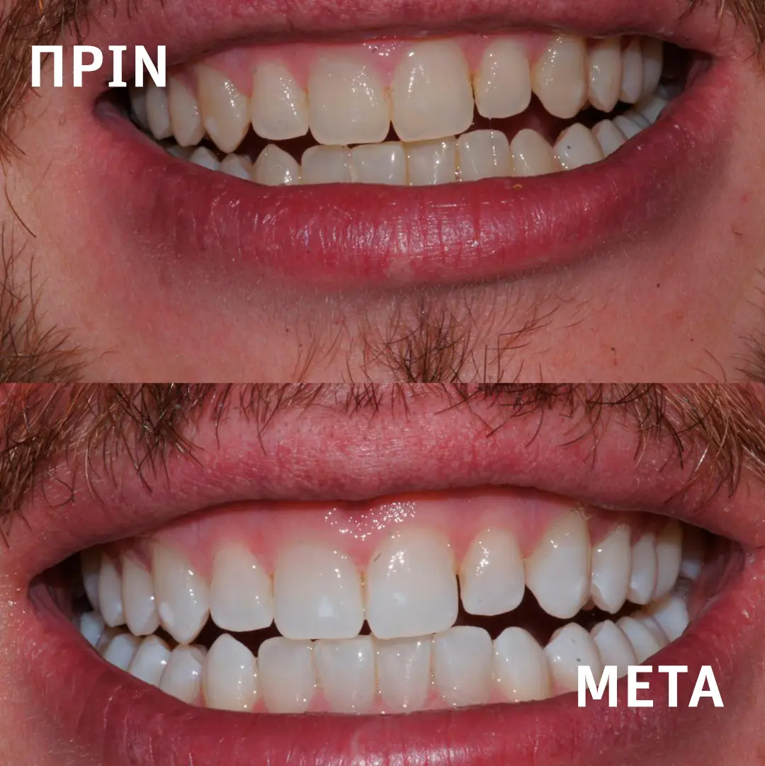 Πρότυπη οδοντιατρική κλινική Σιδέρη Σέρρες. Λεύκανση με διάφανους νάρθηκες