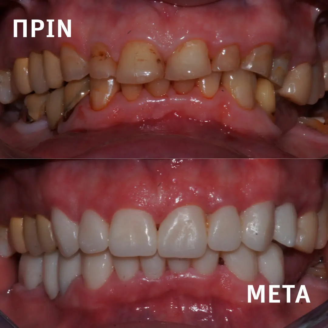 Πρότυπη οδοντιατρική κλινική Σιδέρη Σέρρες. Ολική αποκατάσταση με Ζιρκόνιο