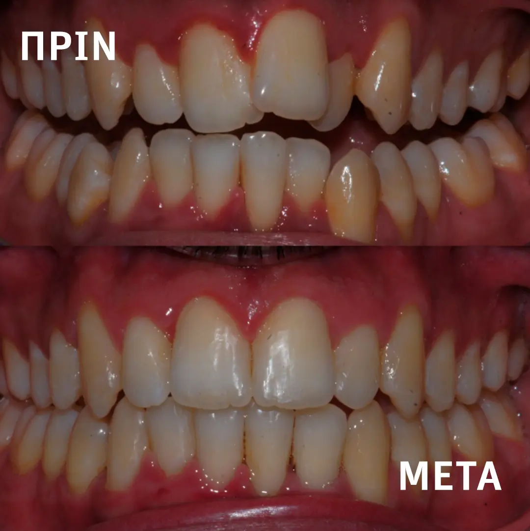 Πρότυπη οδοντιατρική κλινική Σιδέρη Σέρρες. Ορθοδοντική θεραπεία με Aligners