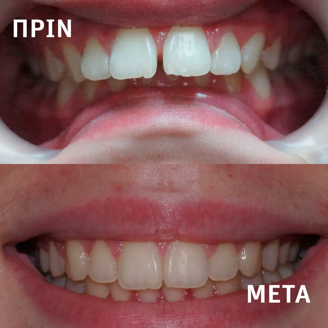 Πρότυπη οδοντιατρική κλινική Σιδέρη Σέρρες. Ορθοδοντική θεραπεία με σιδεράκια.